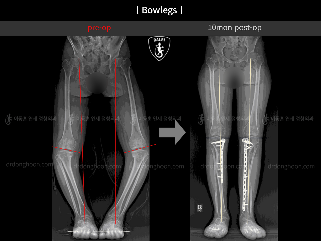 Before and after paediatric & adolescent bowlegs, case 12362822, image 3, Dr. Donghoon institute (DALRI)
