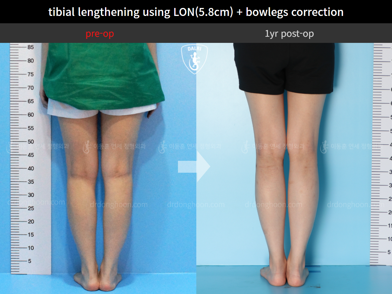 Before and after cll + deformity correction, case 11210566, image 6, Dr. Donghoon institute (DALRI)