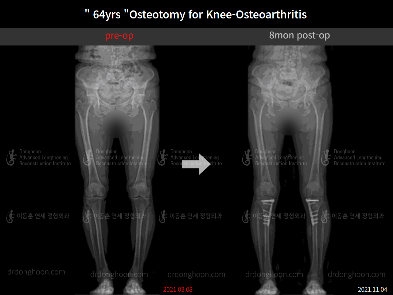 Before and after osteotomy for knee osteoarthritis, case 8761106, image 6, Dr. Donghoon institute (DALRI)
