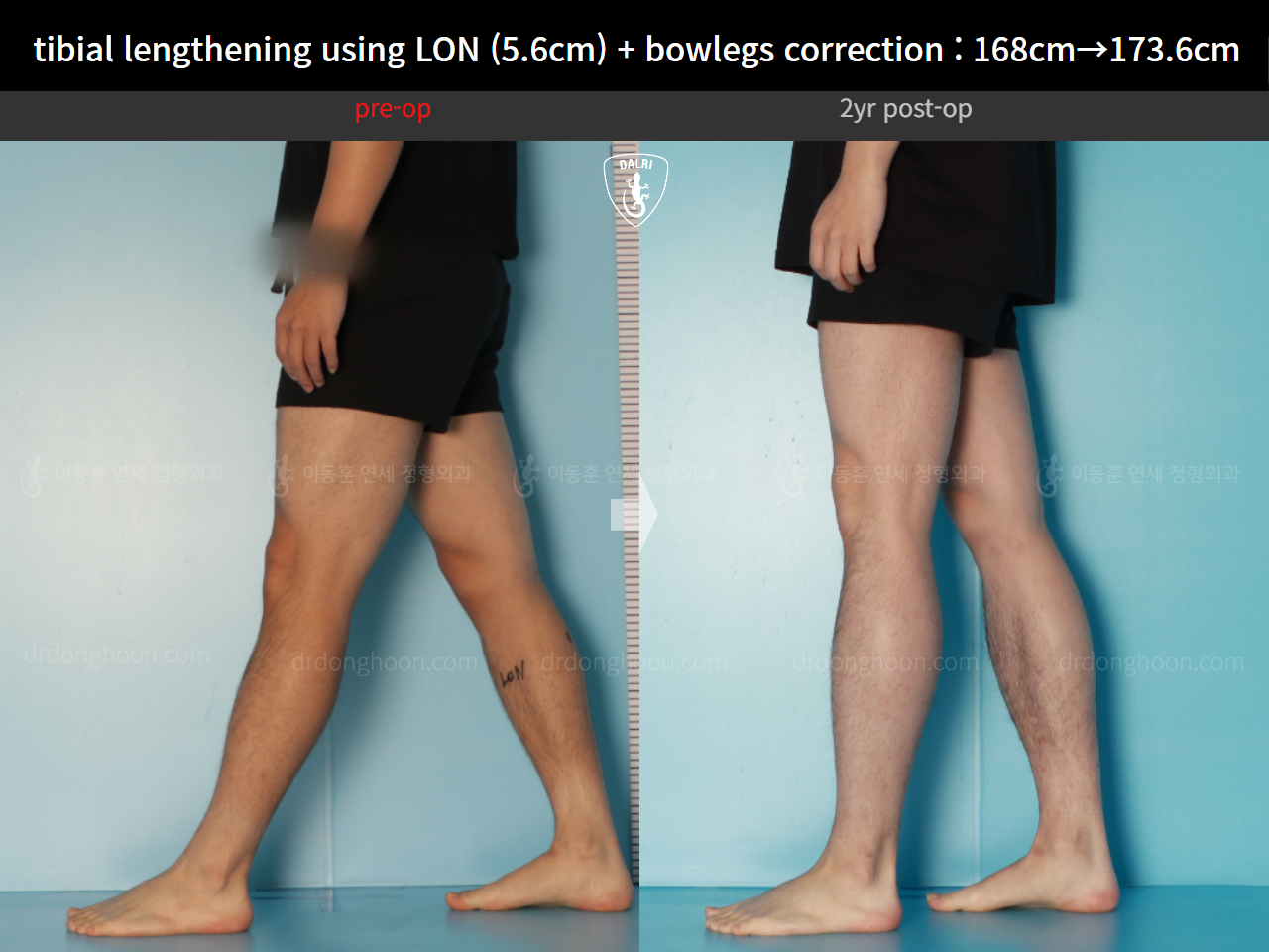 Before and after cll + deformity correction, case 17361975, image 8, Dr. Donghoon institute (DALRI)