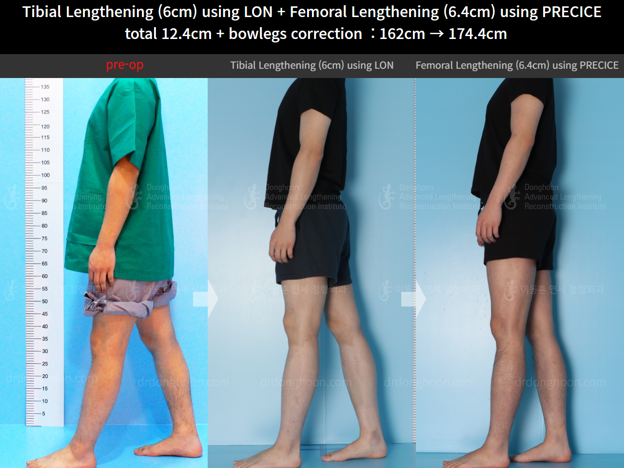 Before and after cll precice, case 14631295, image 4, Dr. Donghoon institute (DALRI)