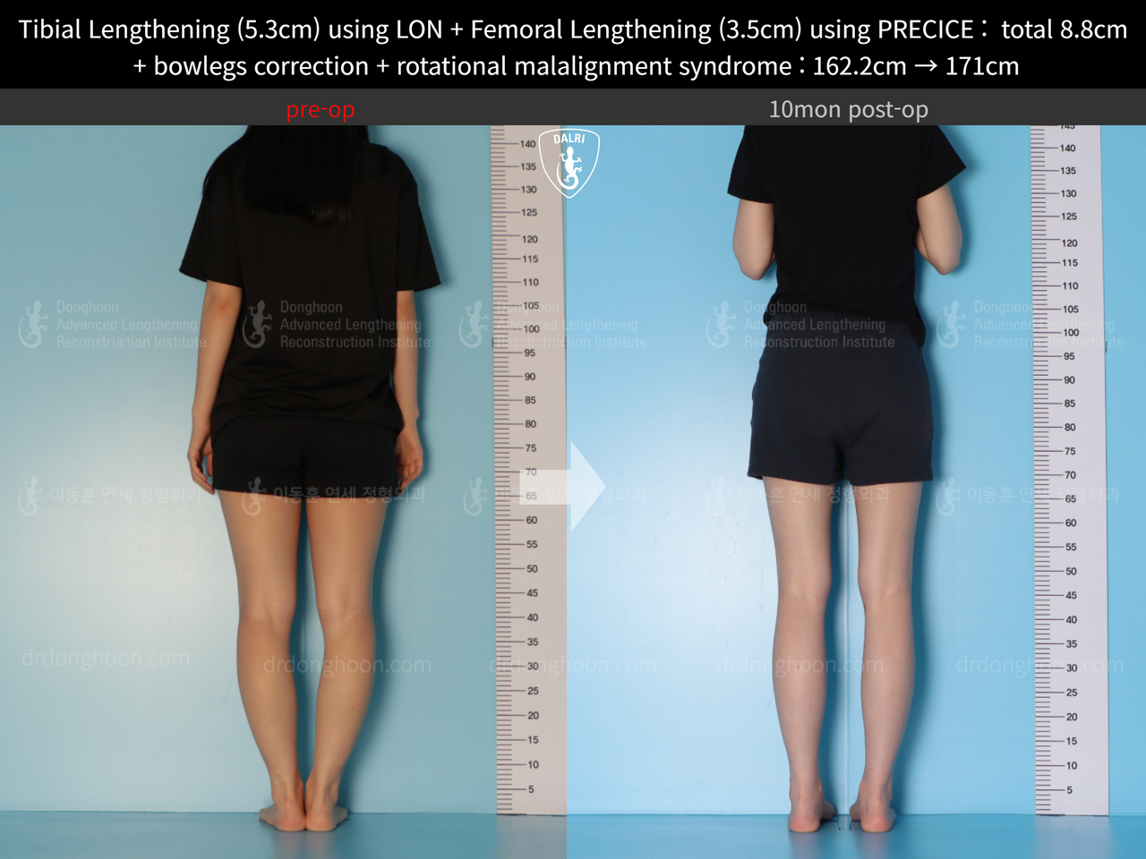 Before and after cll + deformity correction, case 13127167, image 4, Dr. Donghoon institute (DALRI)