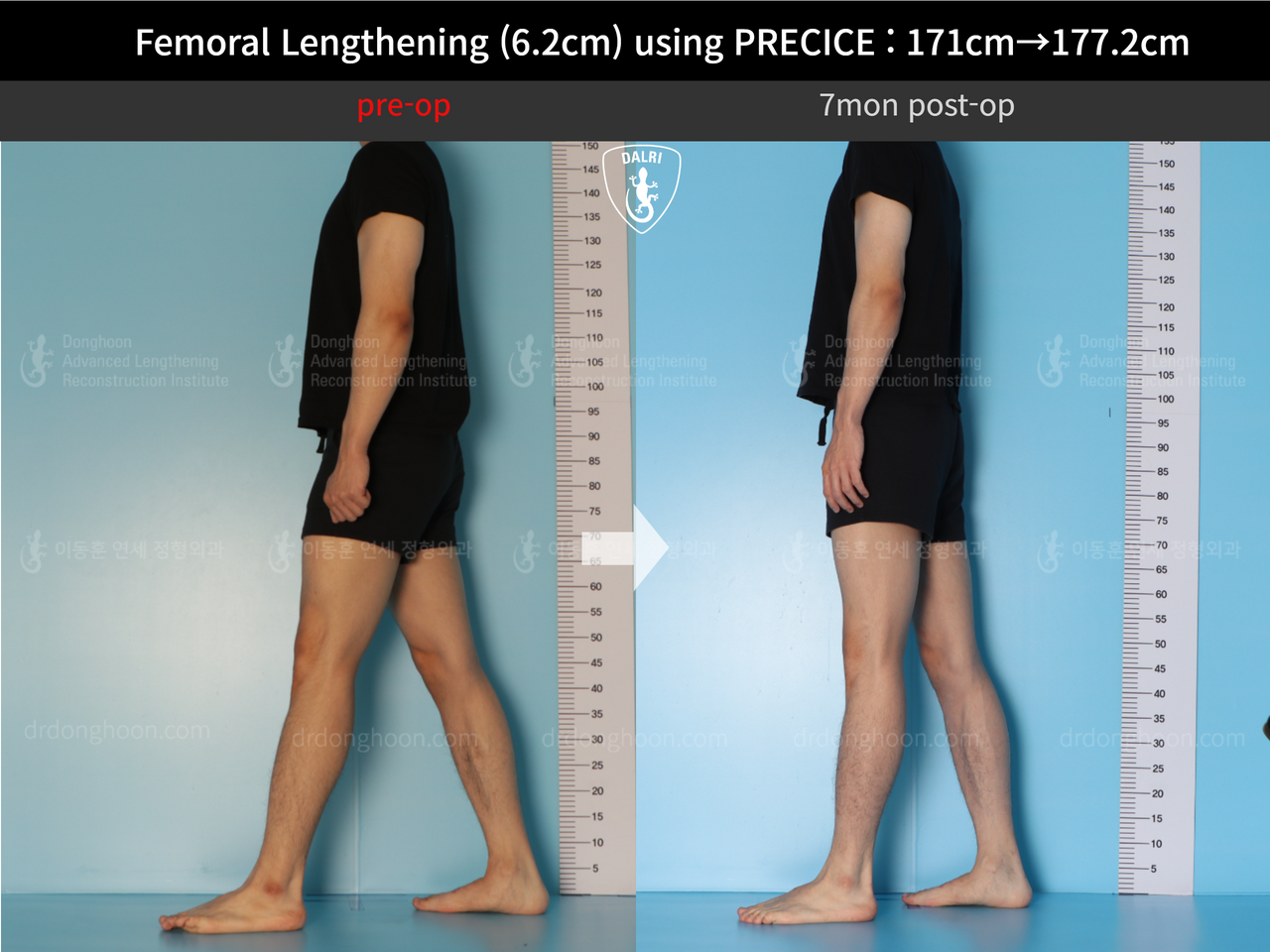 Before and after cll precice, case 13325833, image 7, Dr. Donghoon institute (DALRI)