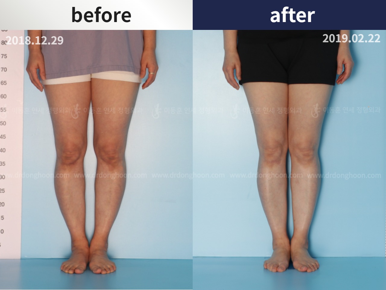 Before and after adult bowlegs, case 4586179, image 1, Dr. Donghoon institute (DALRI)