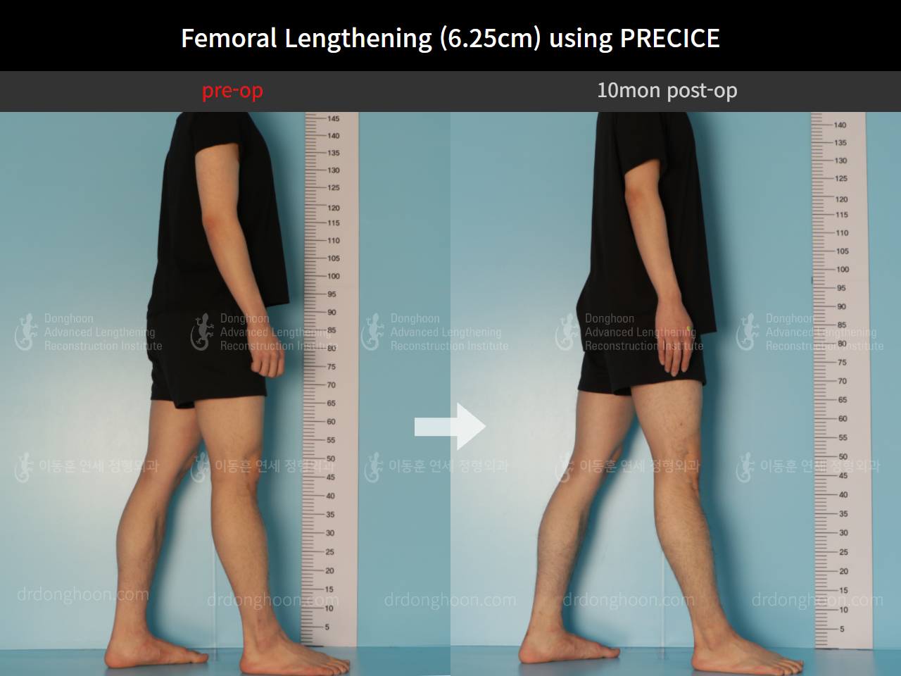 Before and after cll precice, case 8759307, image 3, Dr. Donghoon institute (DALRI)