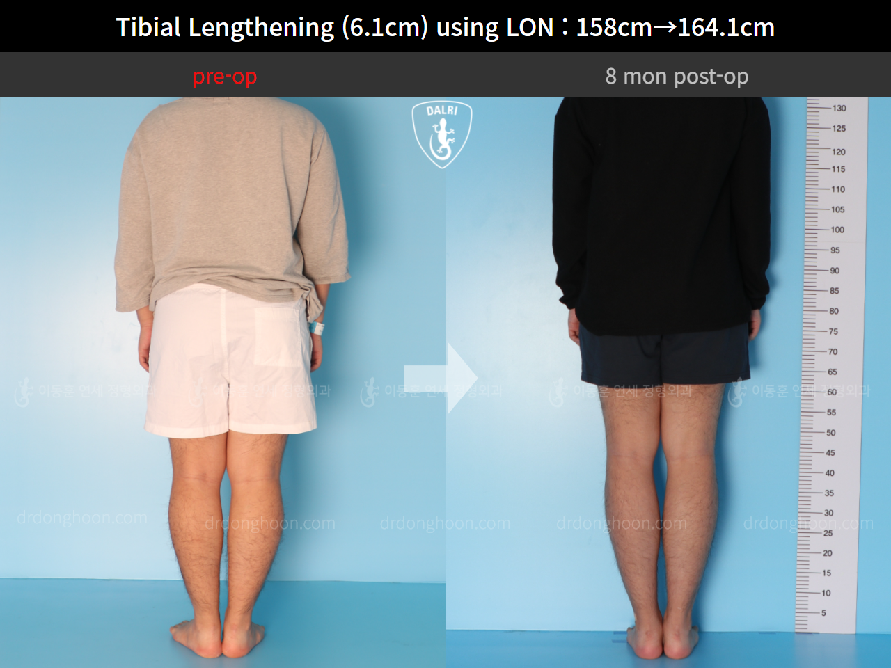 Before and after cll lon, case 4577743, image 2, Dr. Donghoon institute (DALRI)