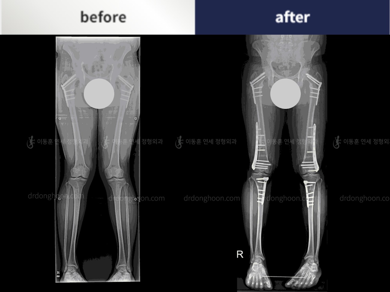 Before and after adult knock knees, case 4310826, image 3, Dr. Donghoon institute (DALRI)