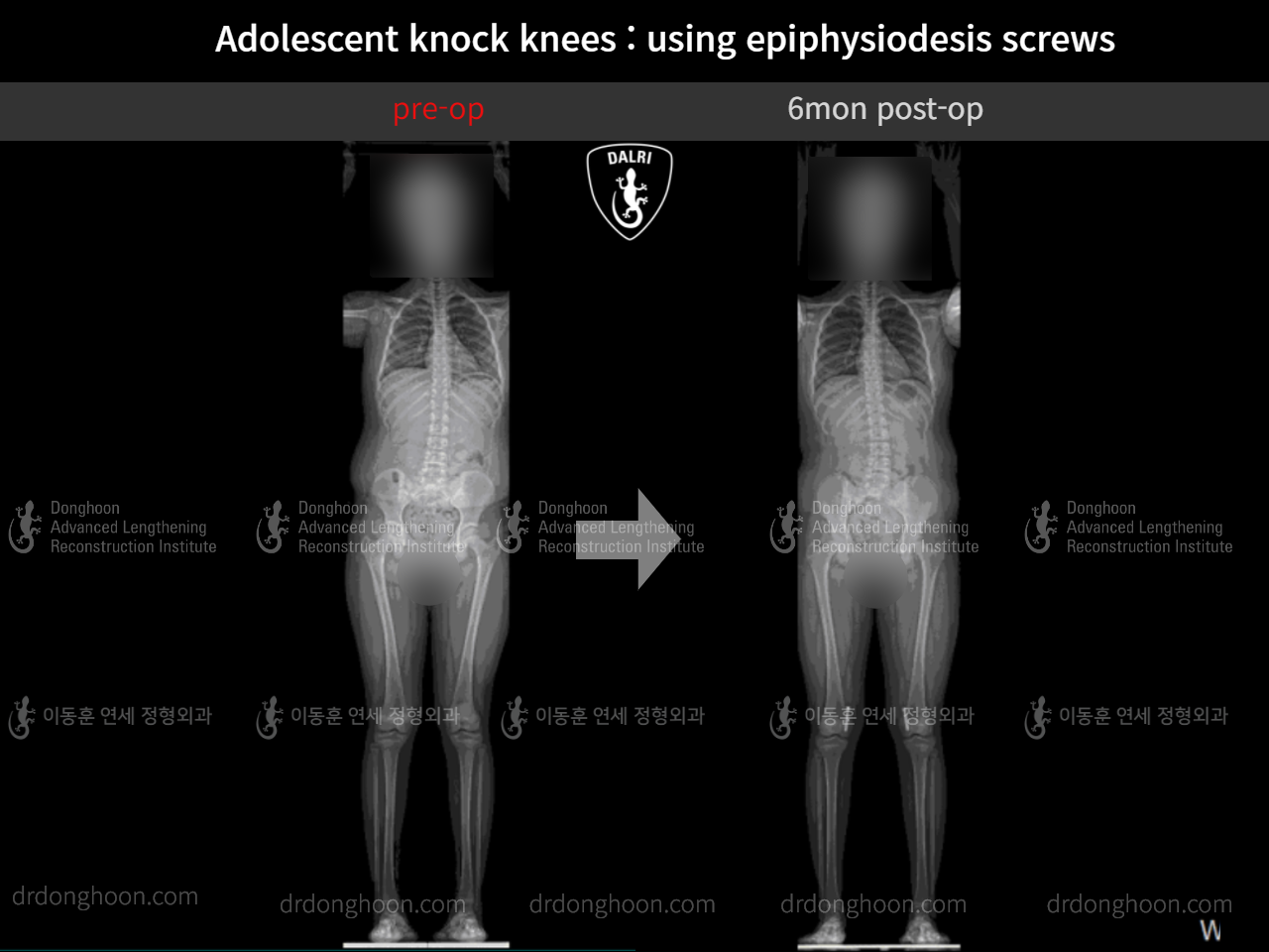 Before and after paediatric & adolescent knock knees, case 9626556, image 6, Dr. Donghoon institute (DALRI)