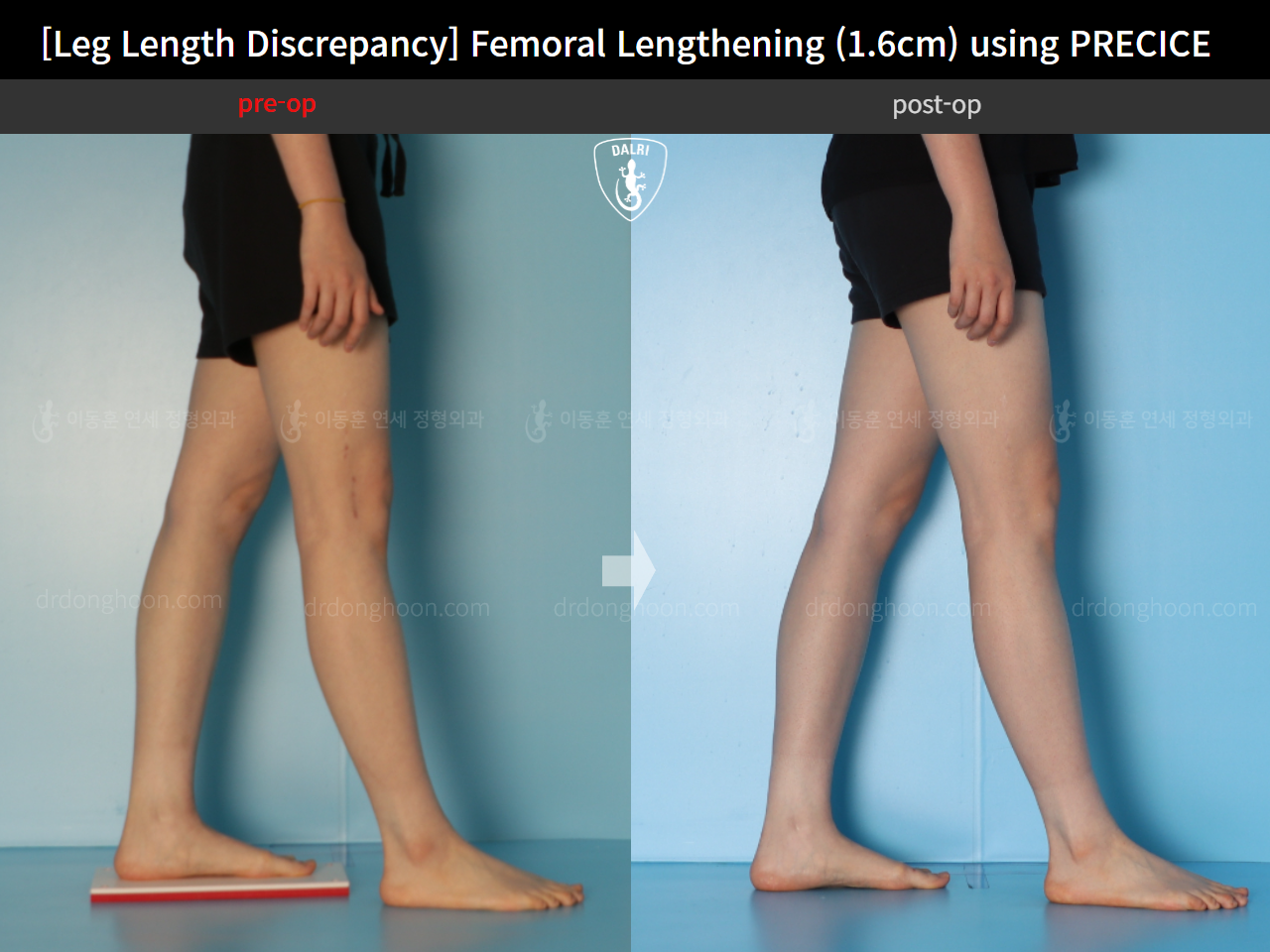 Before and after adult lld, case 15705968, image 10, Dr. Donghoon institute (DALRI)