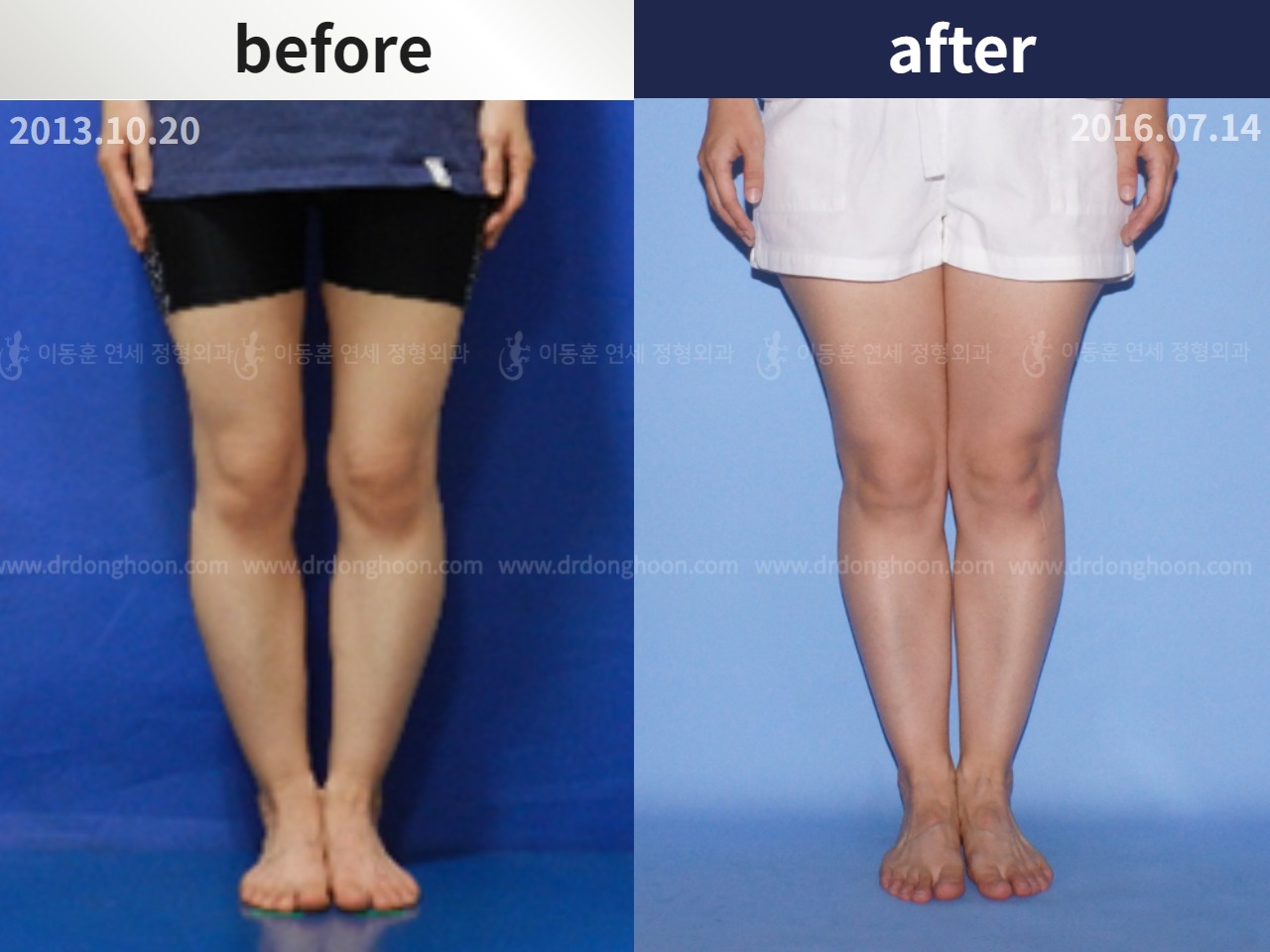Before and after adult bowlegs, case 4311085, image 1, Dr. Donghoon institute (DALRI)