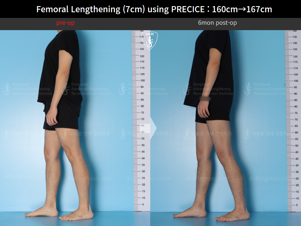 Before and after cll precice, case 15460533, image 6, Dr. Donghoon institute (DALRI)