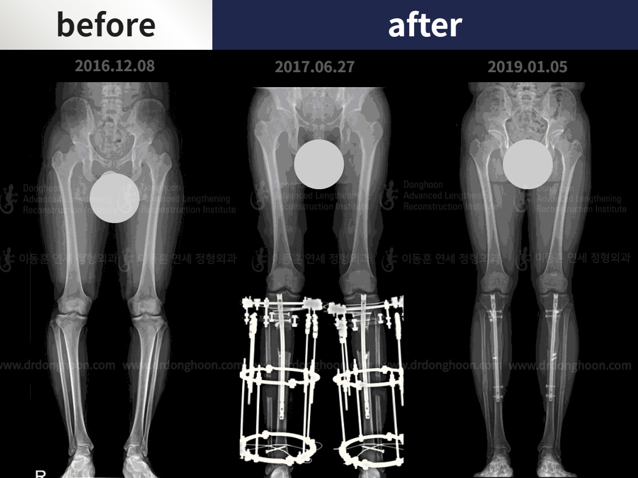 Before and after cll + deformity correction, case 4585650, image 3, Dr. Donghoon institute (DALRI)