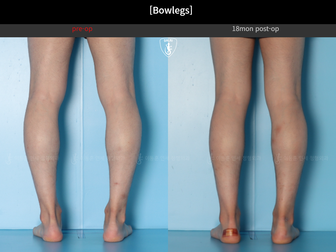 Before and after adult bowlegs, case 124254182, image 10, Dr. Donghoon institute (DALRI)