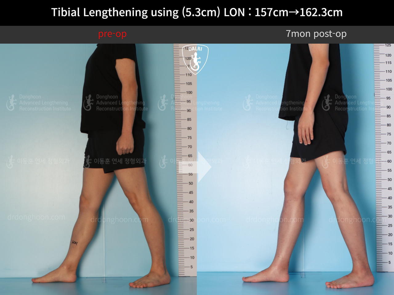 Before and after cll lon, case 12844512, image 5, Dr. Donghoon institute (DALRI)