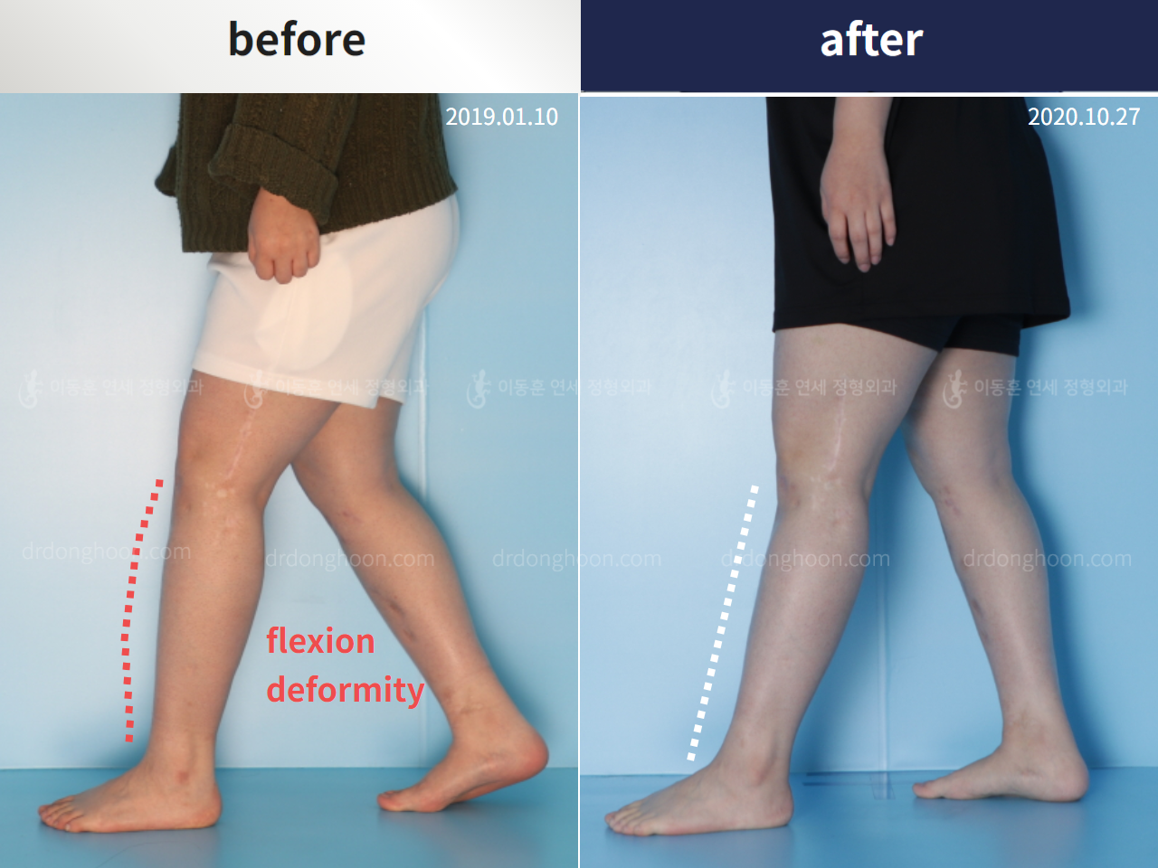 Before and after flexion deformity, case 5271139, image 3, Dr. Donghoon institute (DALRI)