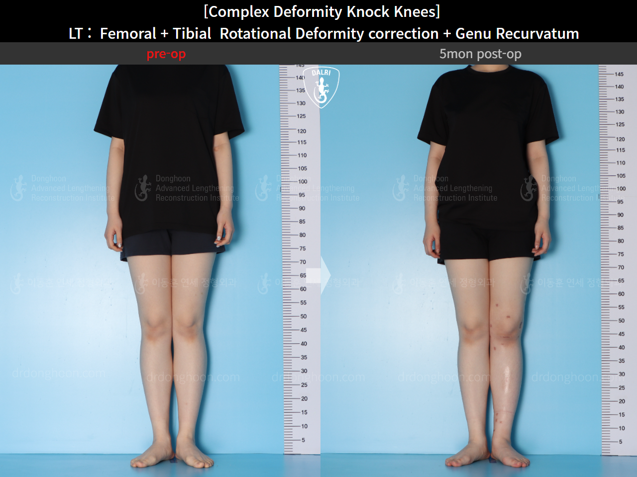 Before and after genu recurvatum, case 16212778, image 3, Dr. Donghoon institute (DALRI)