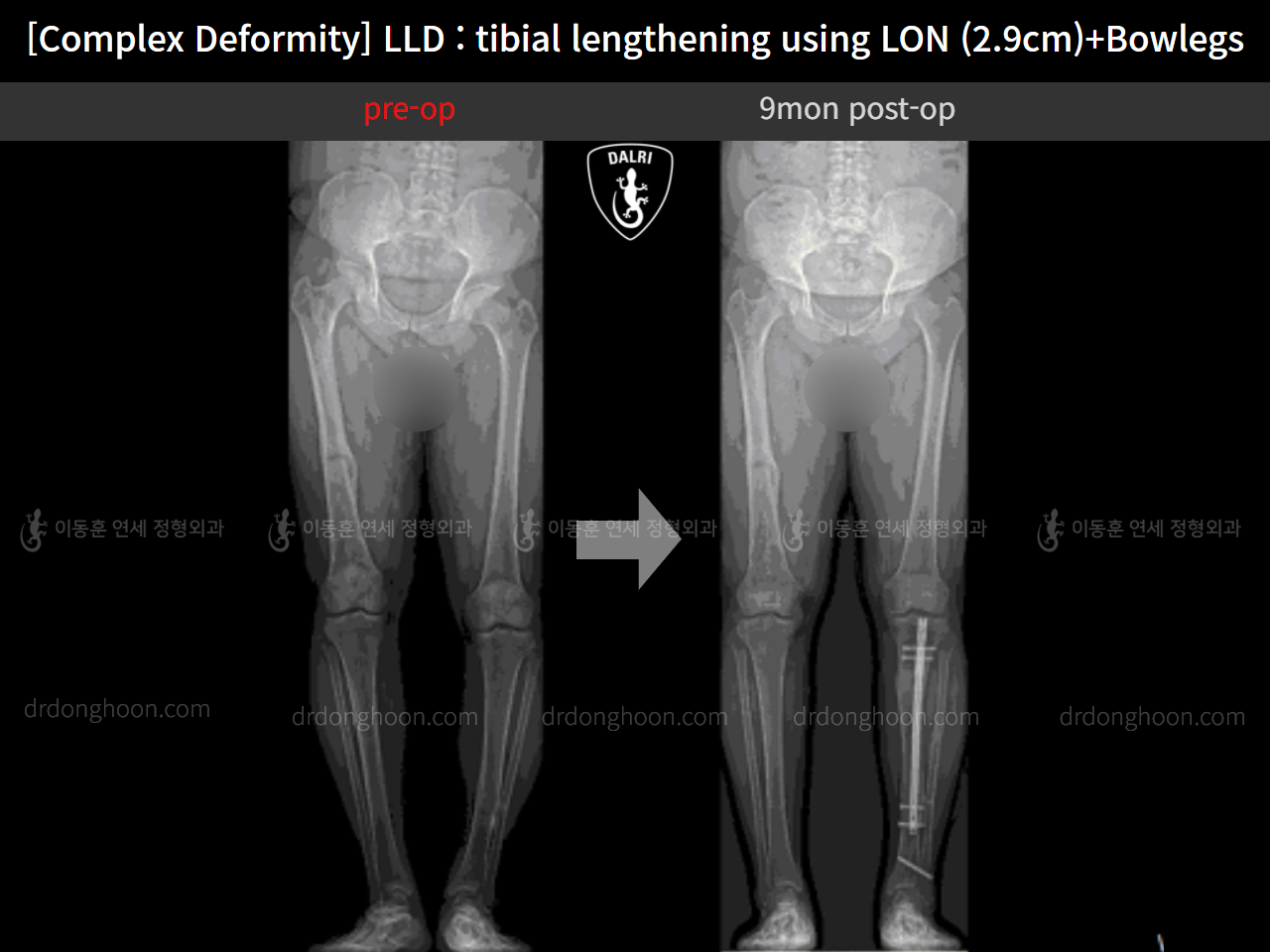 Before and after adult lld, case 11233977, image 8, Dr. Donghoon institute (DALRI)