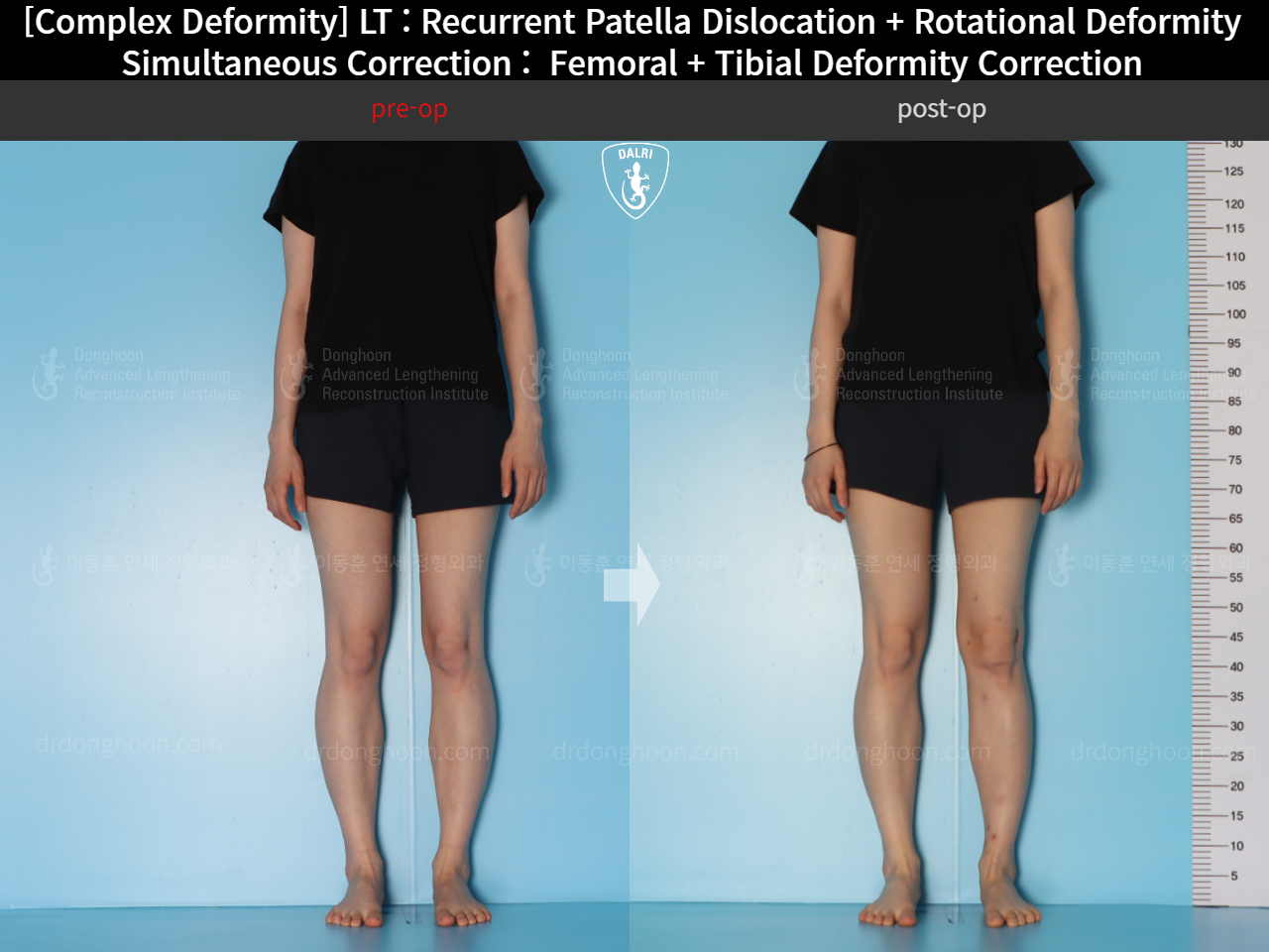 Before and after recurrent patella dislocation, case 18088207, image 7, Dr. Donghoon institute (DALRI)