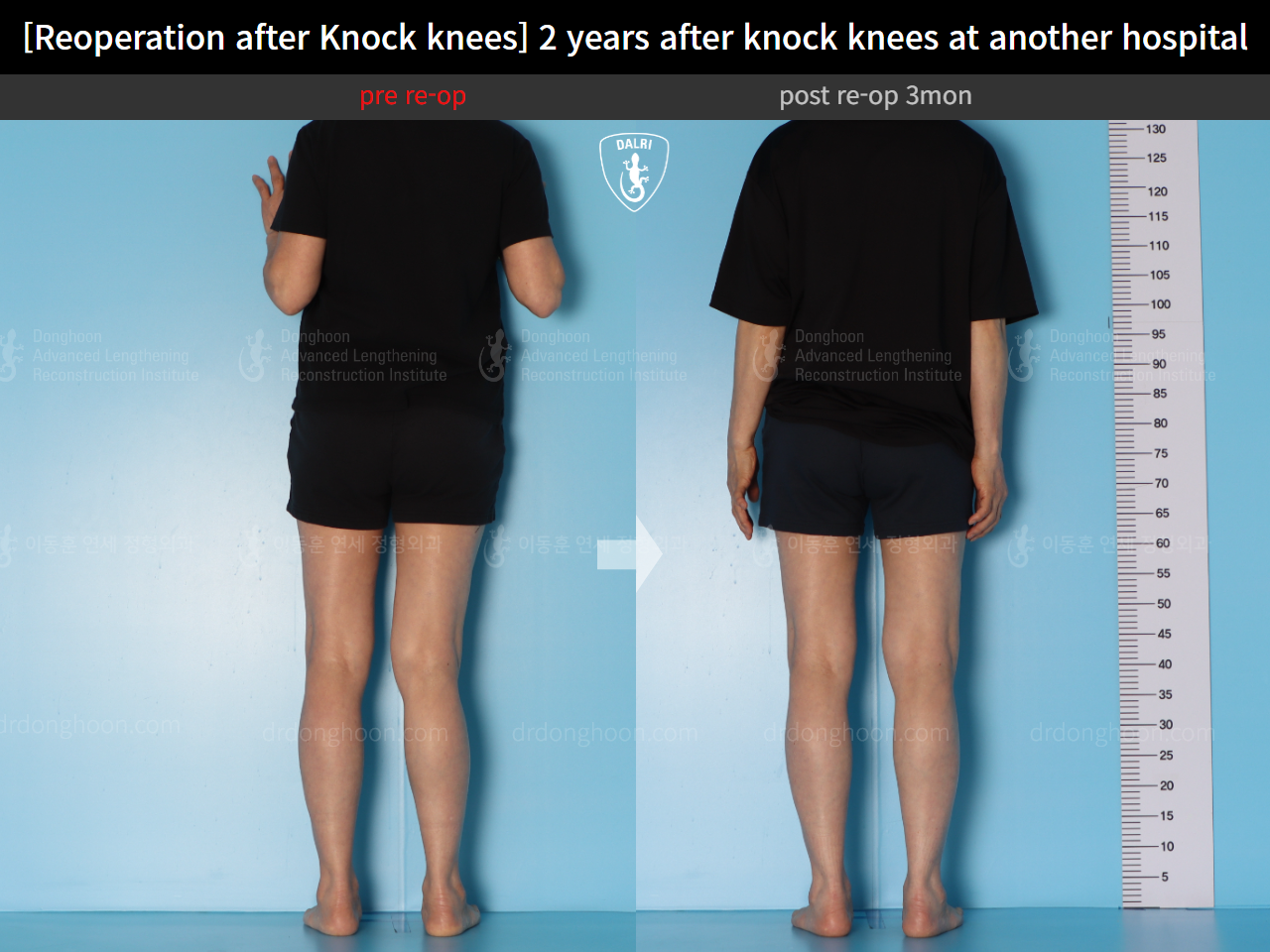 Before and after reoperation after deformity correction, case 15622876, image 5, Dr. Donghoon institute (DALRI)