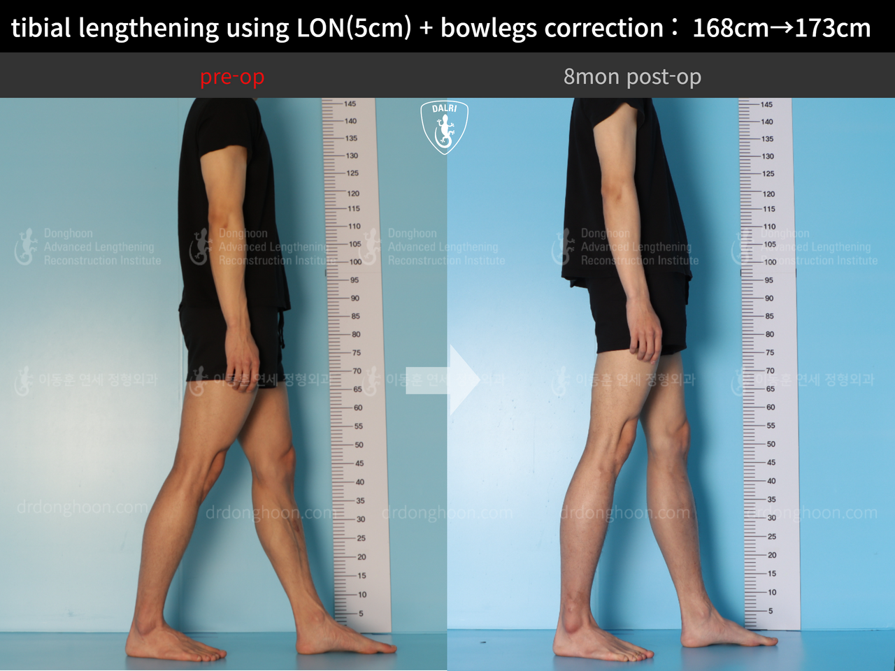 Before and after cll lon, case 13661175, image 4, Dr. Donghoon institute (DALRI)