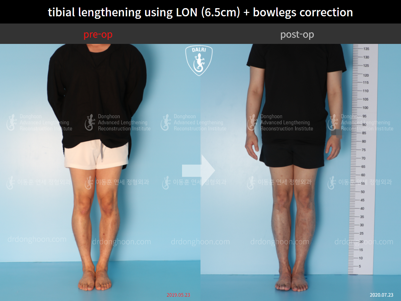 Before and after cll + deformity correction, case 4585639, image 1, Dr. Donghoon institute (DALRI)