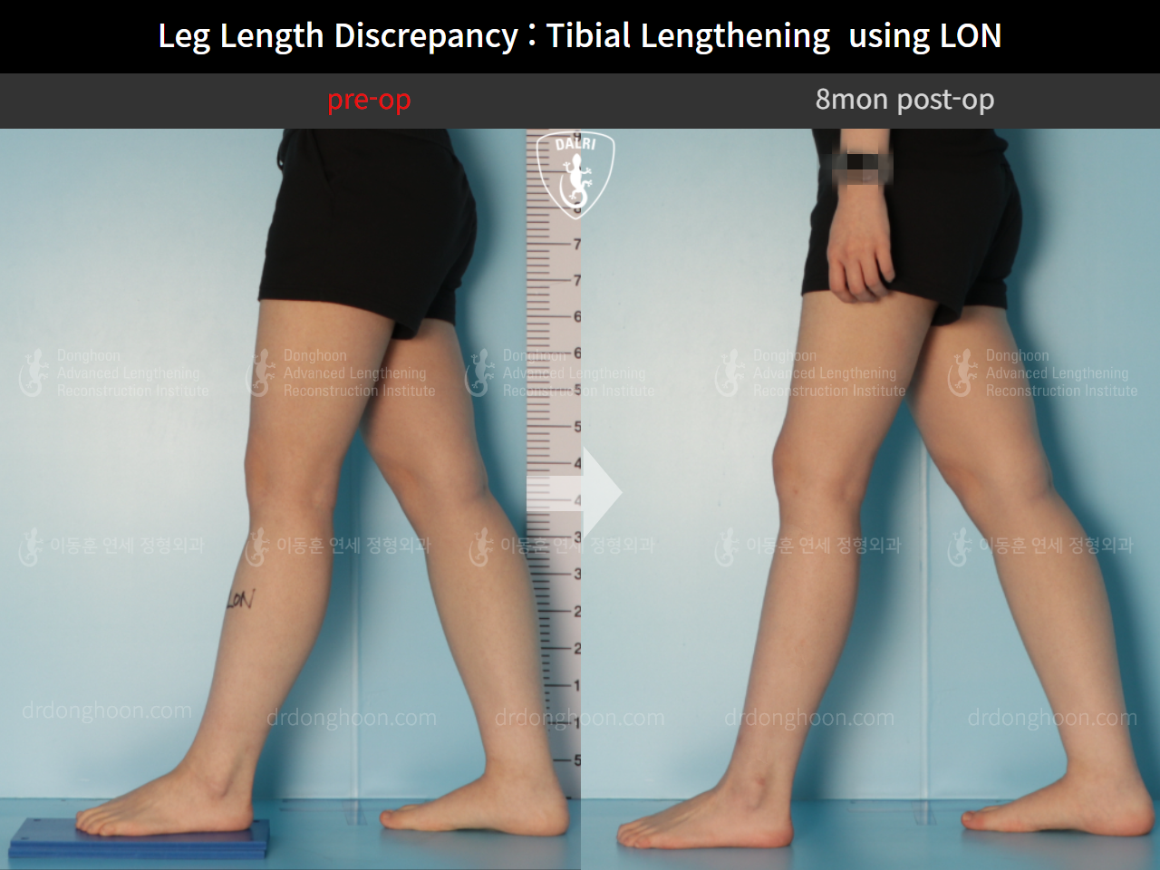 Before and after adult lld, case 10477860, image 6, Dr. Donghoon institute (DALRI)