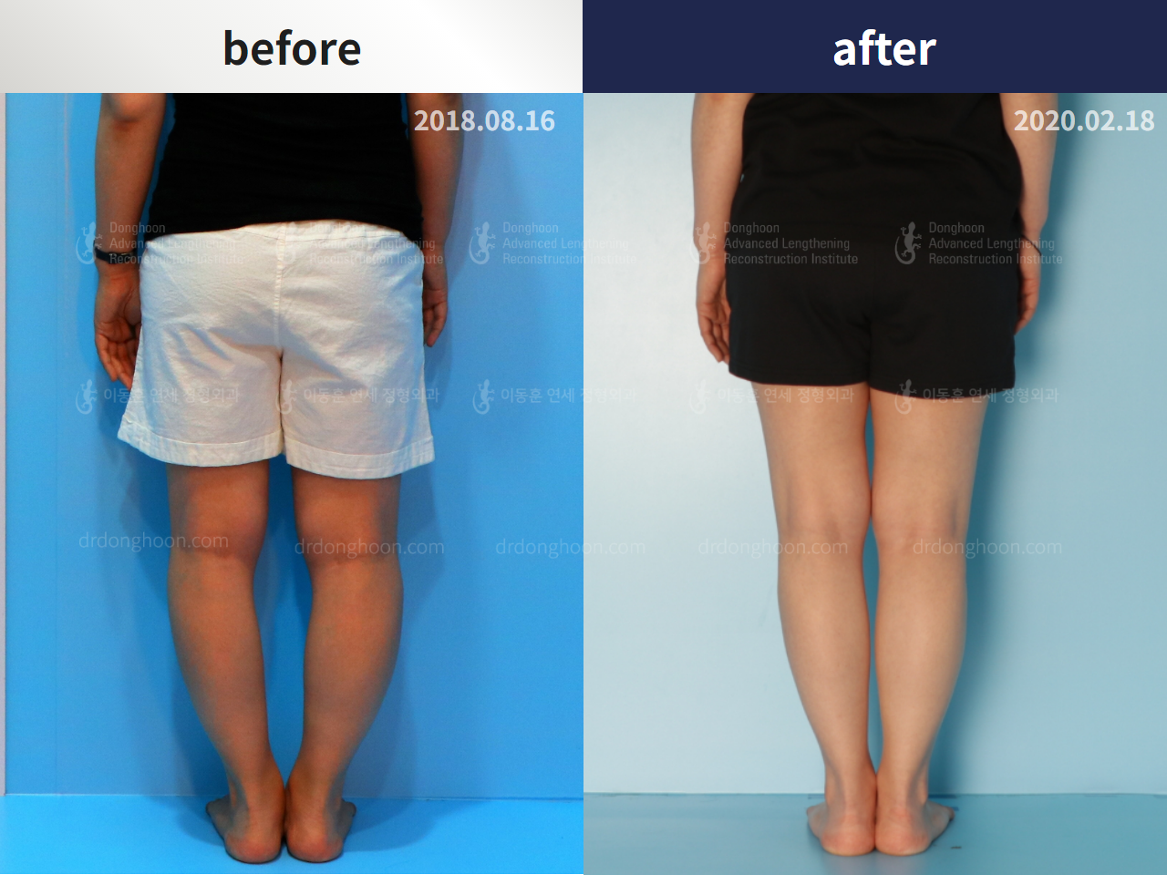 Before and after congenital condition, case 4304638, image 2, Dr. Donghoon institute (DALRI)