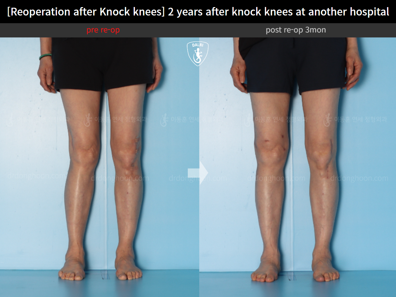 Before and after reoperation after deformity correction, case 15622876, image 8, Dr. Donghoon institute (DALRI)