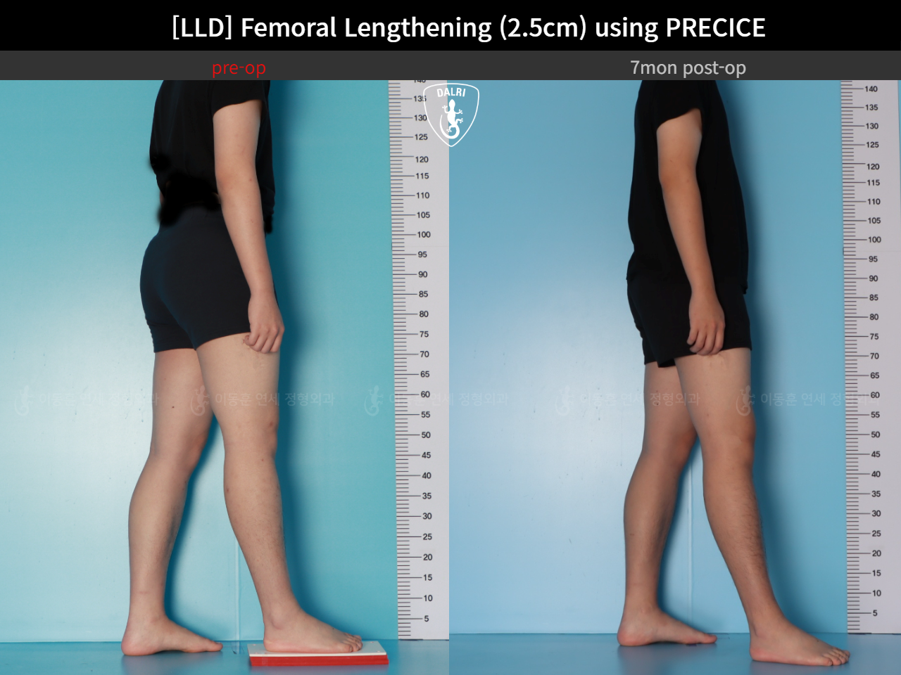Before and after adult lld, case 127180202, image 3, Dr. Donghoon institute (DALRI)