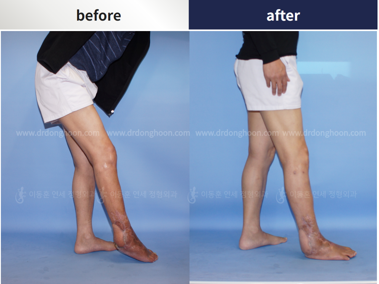 Before and after post-trauma deformity, case 4251787, image 3, Dr. Donghoon institute (DALRI)