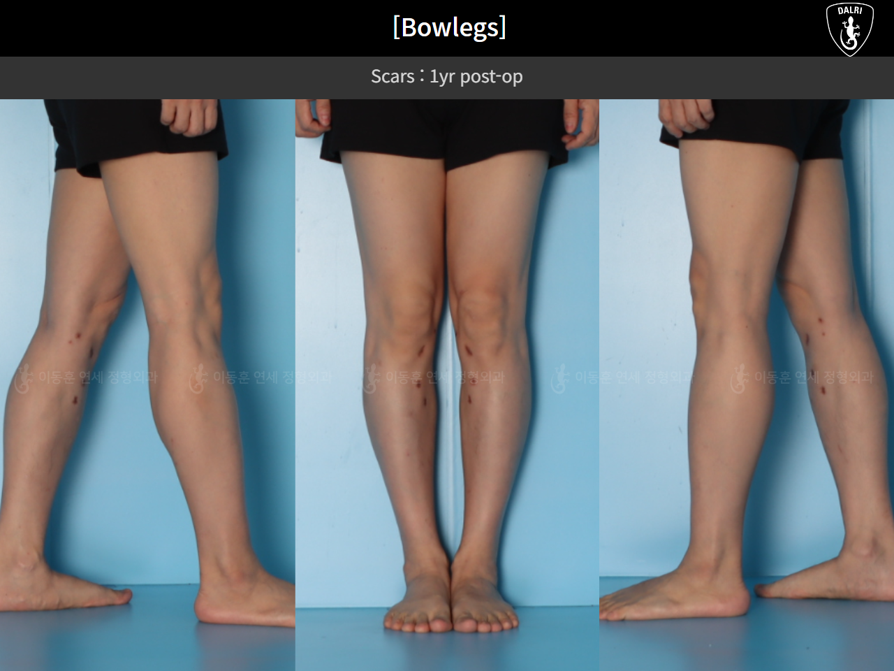 Before and after adult bowlegs, case 125438866, image 12, Dr. Donghoon institute (DALRI)