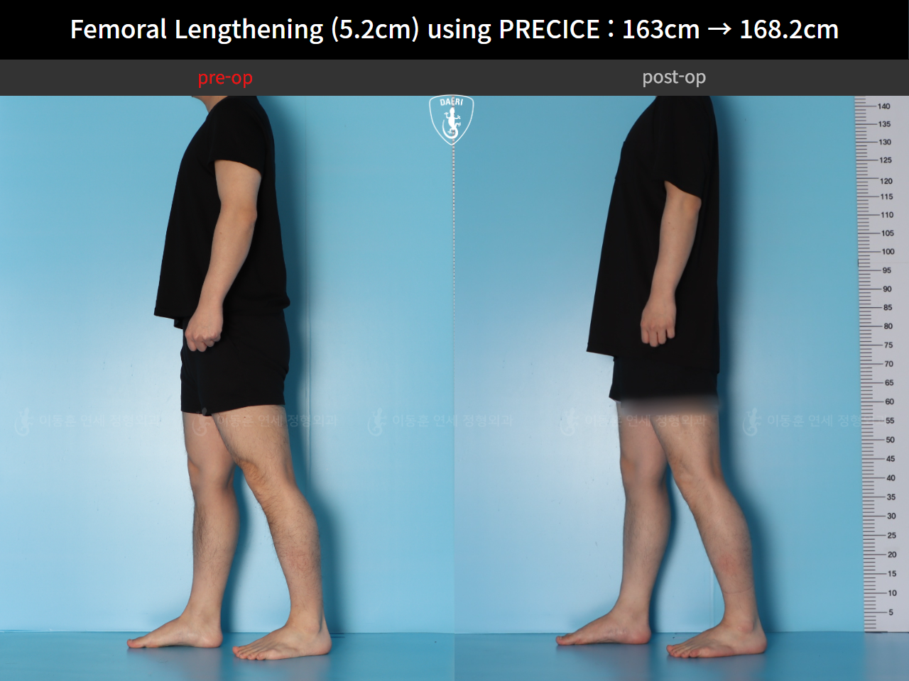 Before and after cll precice, case 55585697, image 4, Dr. Donghoon institute (DALRI)