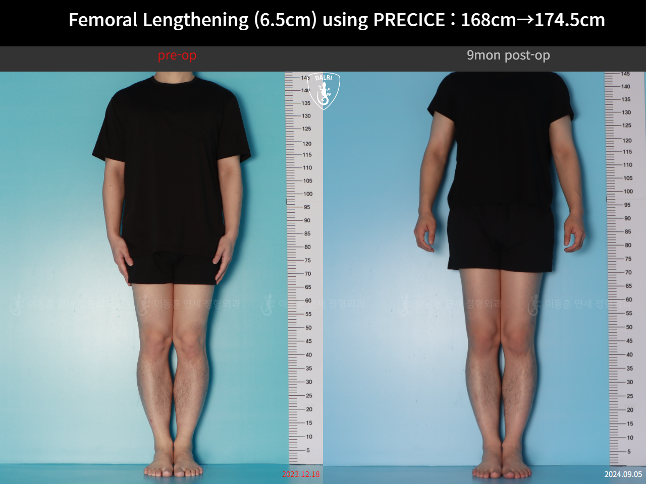 Before and after cll precice, case 123911358, image 1, Dr. Donghoon institute (DALRI)