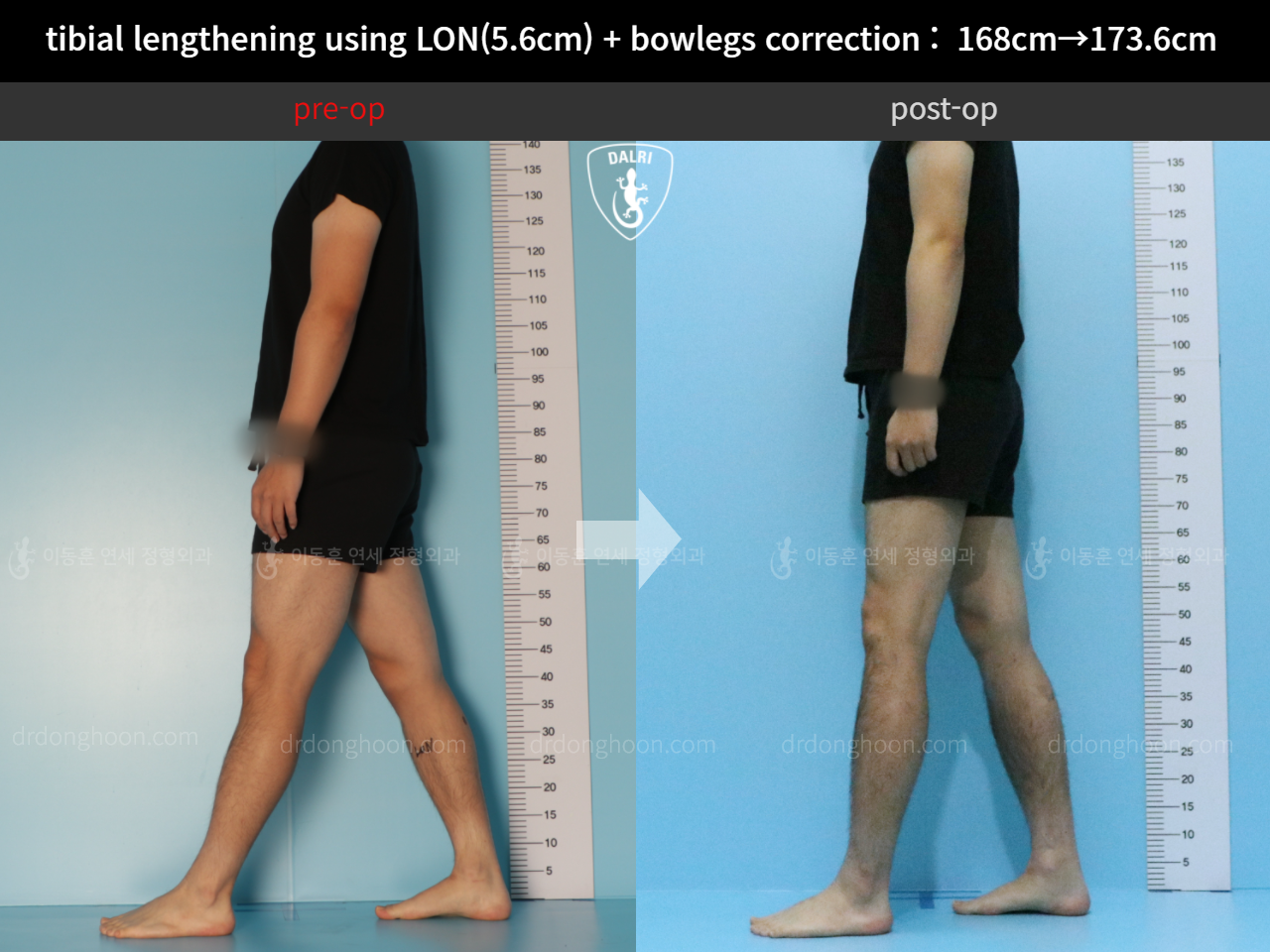 Before and after cll + deformity correction, case 11802994, image 4, Dr. Donghoon institute (DALRI)