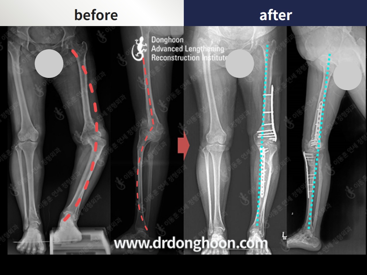 Before and after complex deformity, case 4762640, image 1, Dr. Donghoon institute (DALRI)