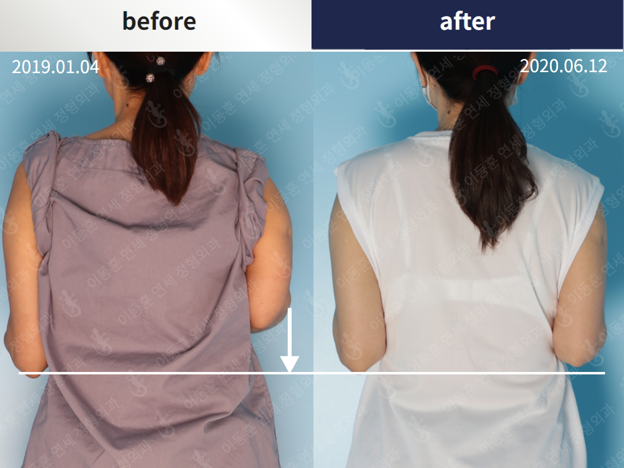 Before and after arm lengthening, case 4249436, image 1, Dr. Donghoon institute (DALRI)