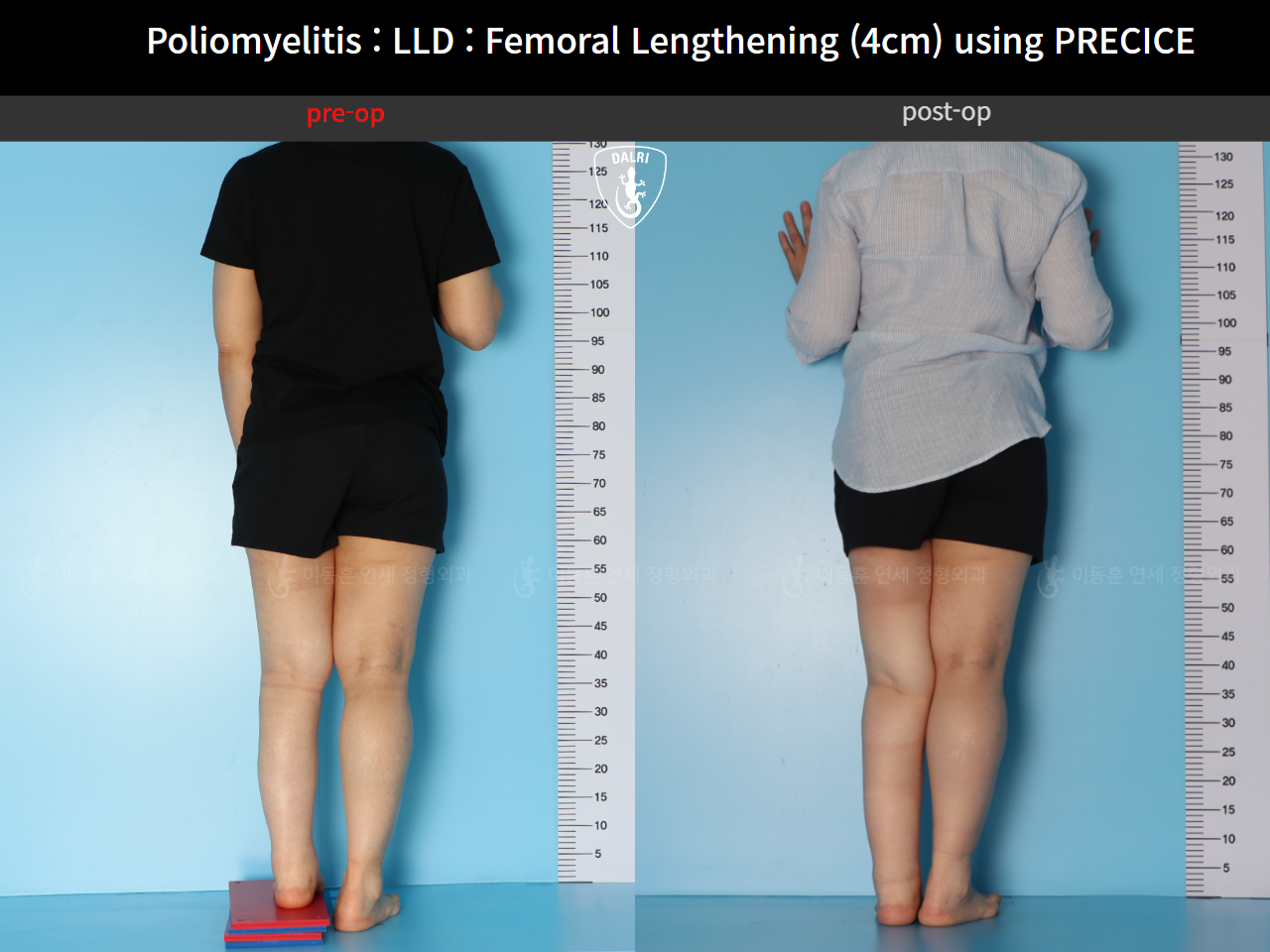 Before and after congenital condition, case 91244014, image 2, Dr. Donghoon institute (DALRI)