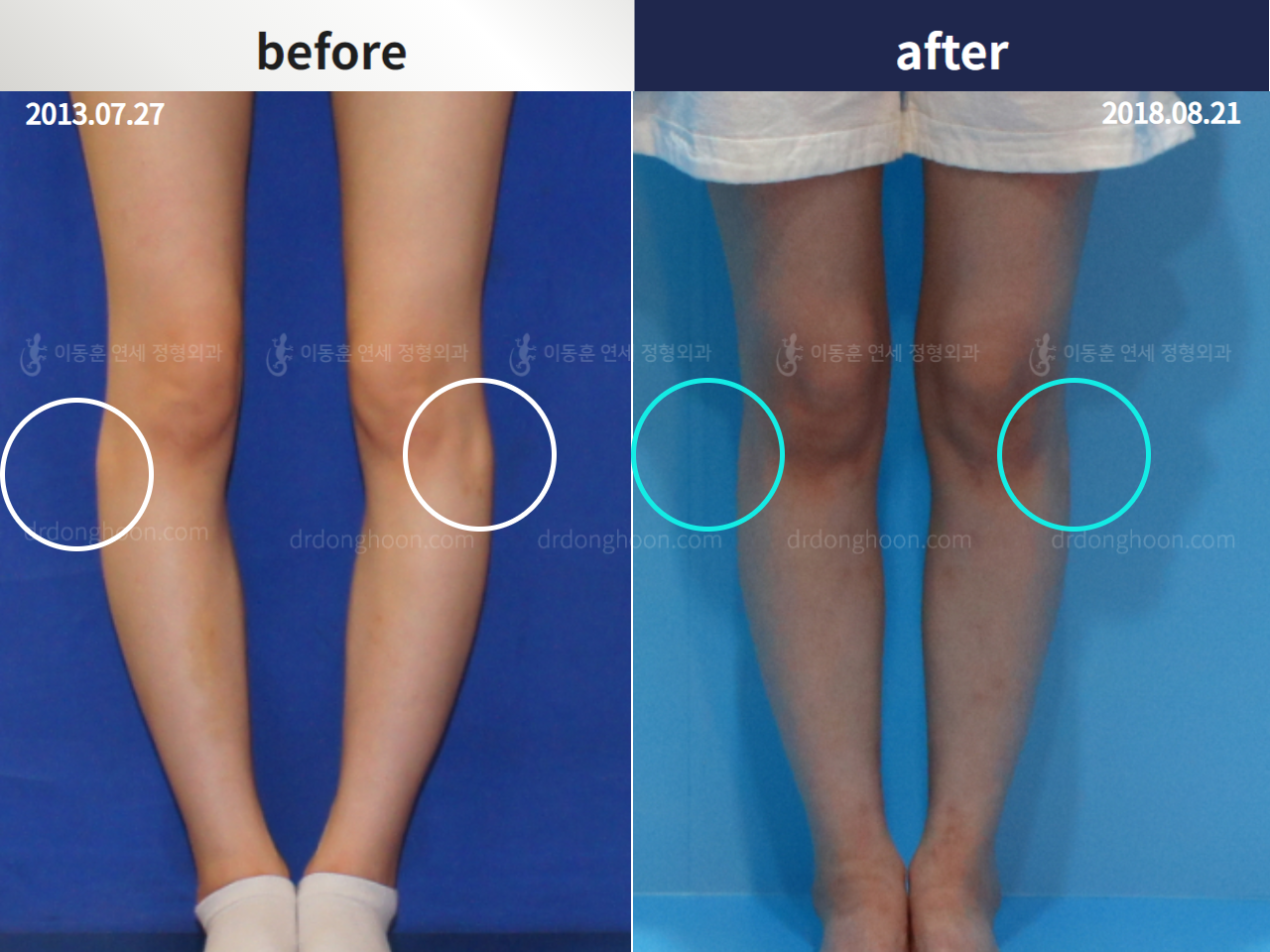 Before and after protruded fibular head, case 4368363, image 2, Dr. Donghoon institute (DALRI)