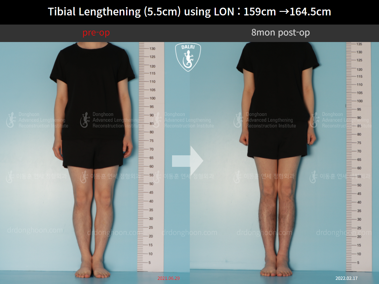 Before and after cll lon, case 10444923, image 1, Dr. Donghoon institute (DALRI)