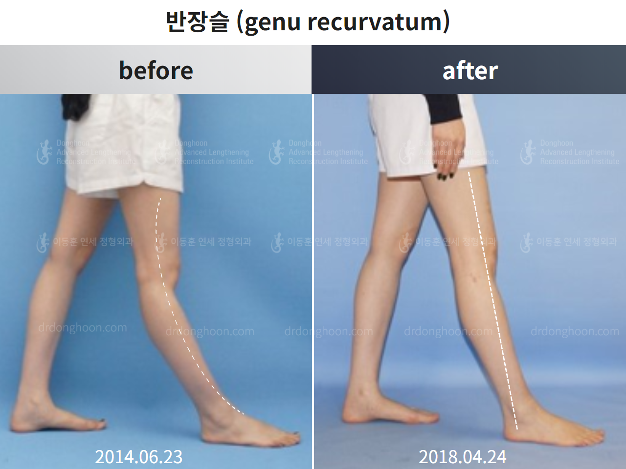 Before and after adult lld, case 4472980, image 4, Dr. Donghoon institute (DALRI)