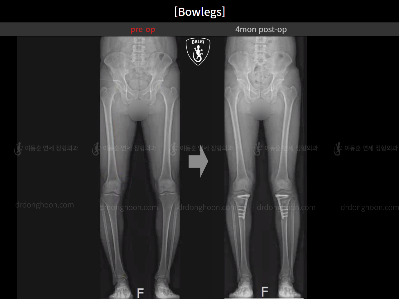 Before and after adult bowlegs, case 15650289, image 9, Dr. Donghoon institute (DALRI)