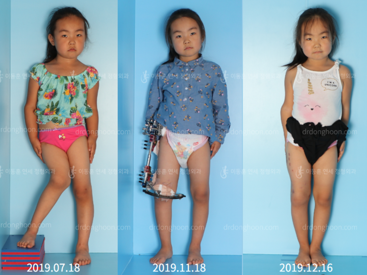 Before and after paediatric congenital condition, case 4304803, image 1, Dr. Donghoon institute (DALRI)