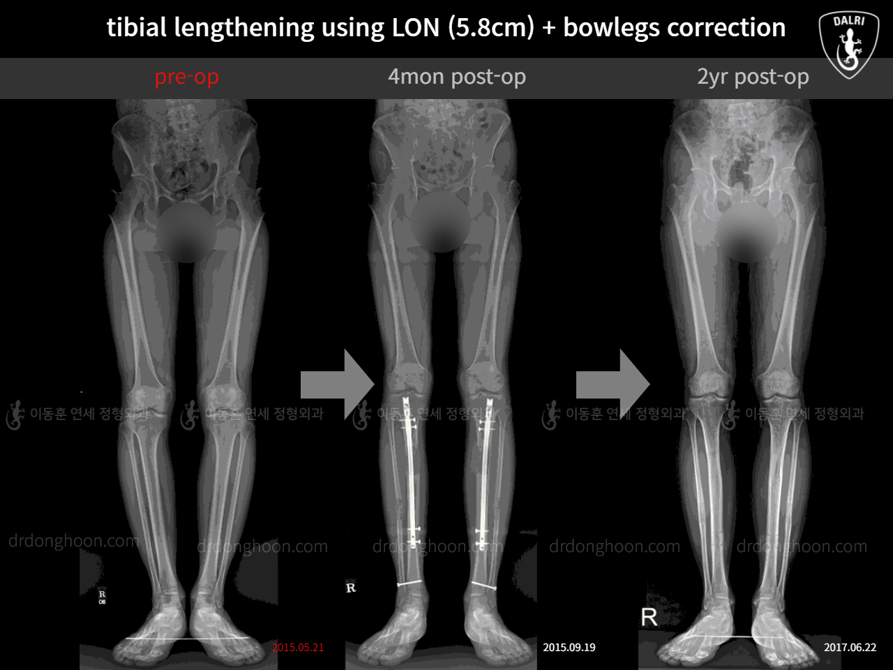 Before and after cll + deformity correction, case 11367030, image 3, Dr. Donghoon institute (DALRI)