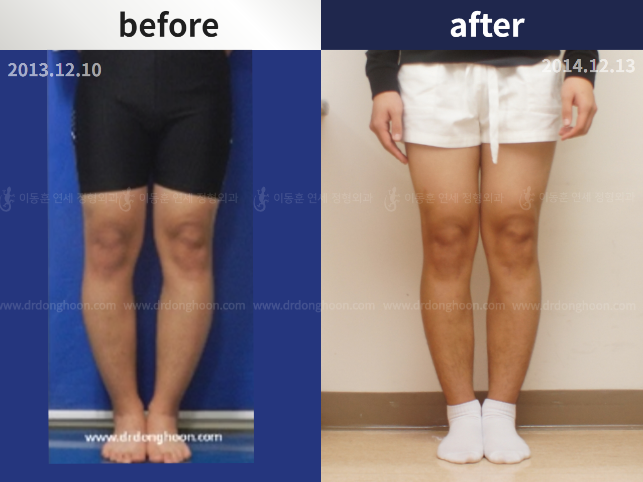 Before and after paediatric & adolescent bowlegs, case 4320236, image 1, Dr. Donghoon institute (DALRI)