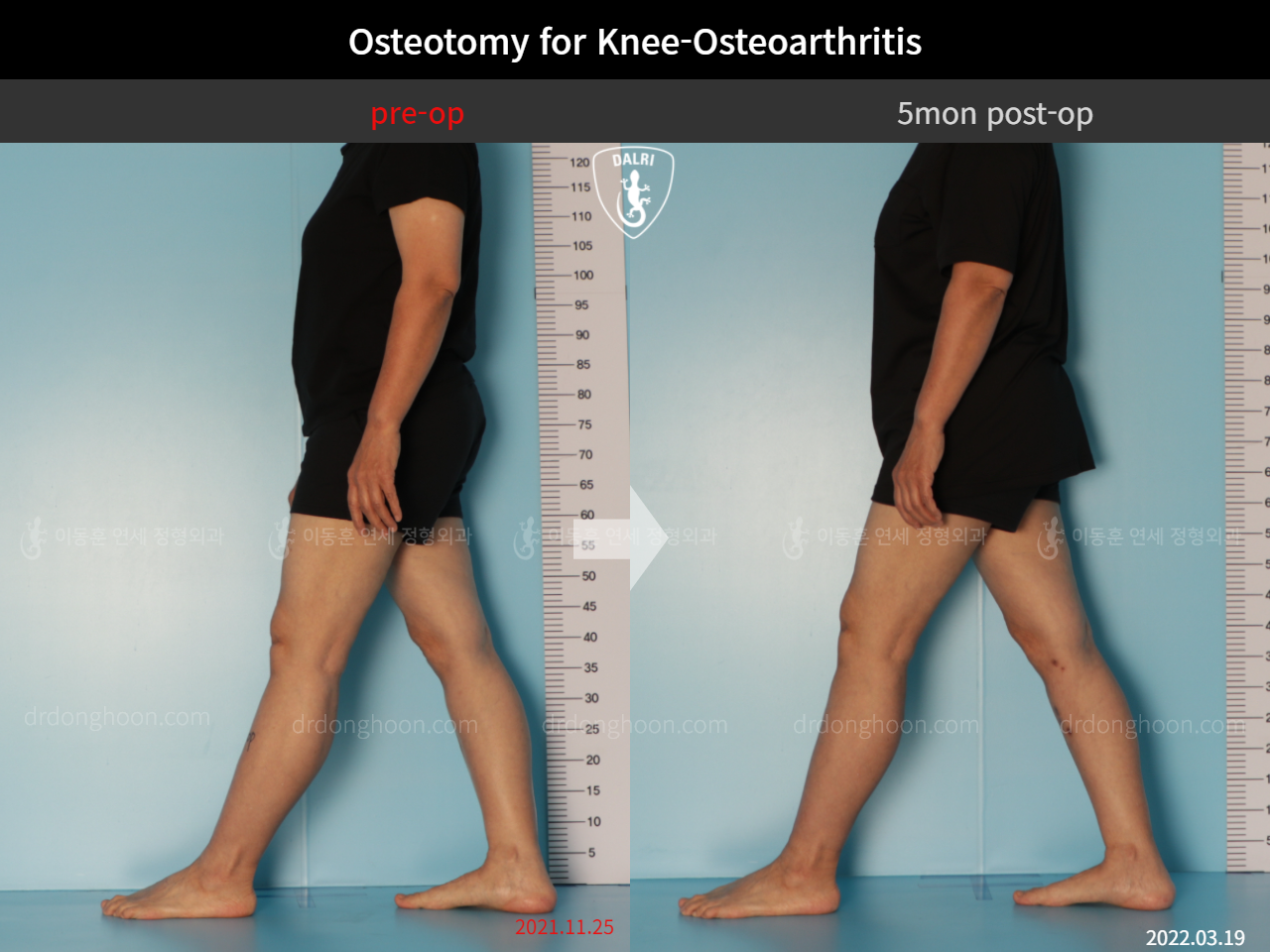 Before and after osteotomy for knee osteoarthritis, case 11047064, image 4, Dr. Donghoon institute (DALRI)