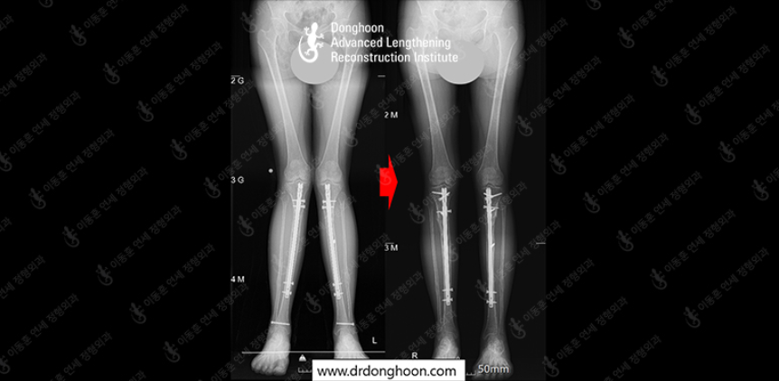 Before and after re-operation for cll, case 4520587, image 1, Dr. Donghoon institute (DALRI)