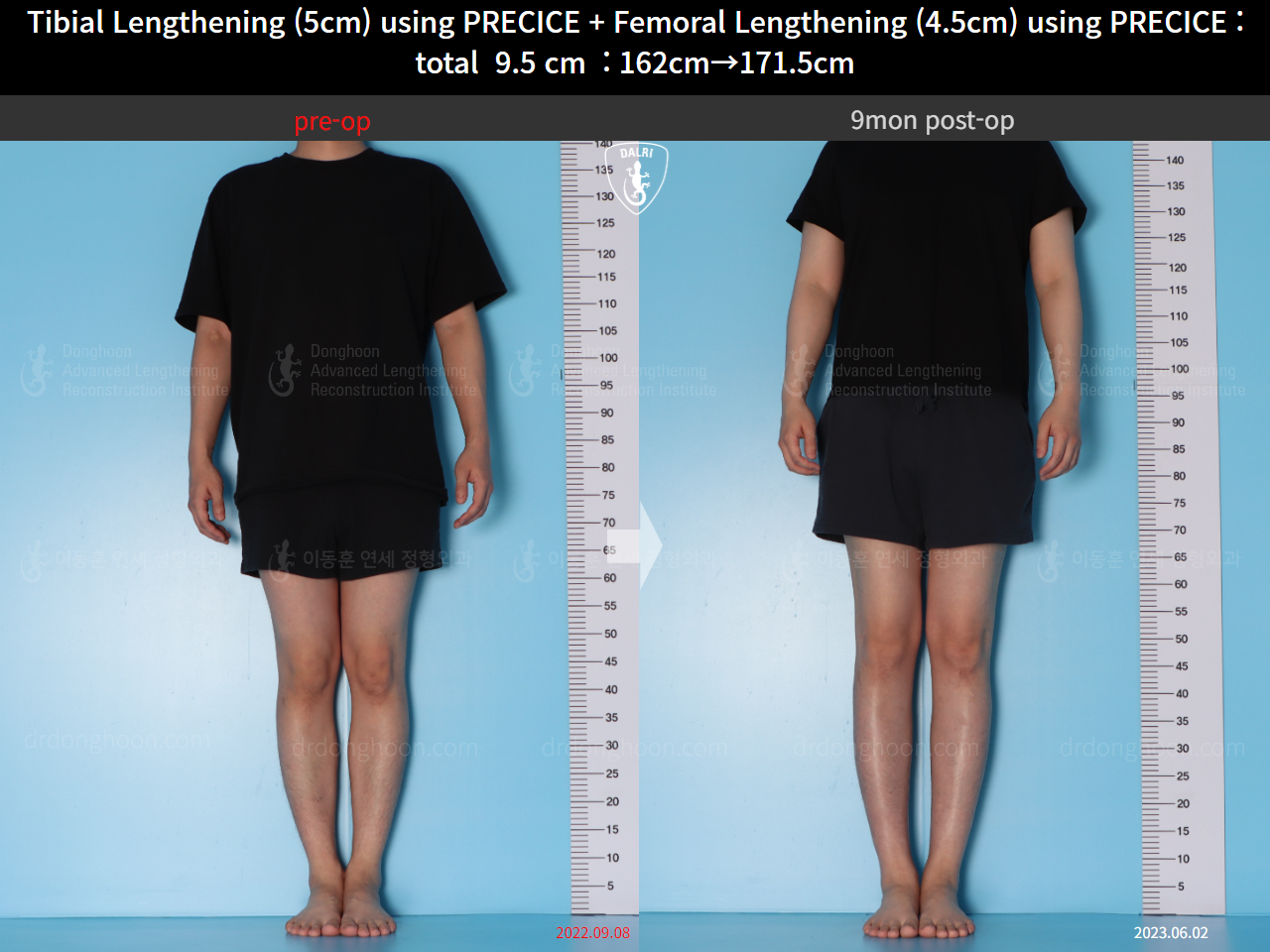 Before and after cll precice, case 15344460, image 1, Dr. Donghoon institute (DALRI)