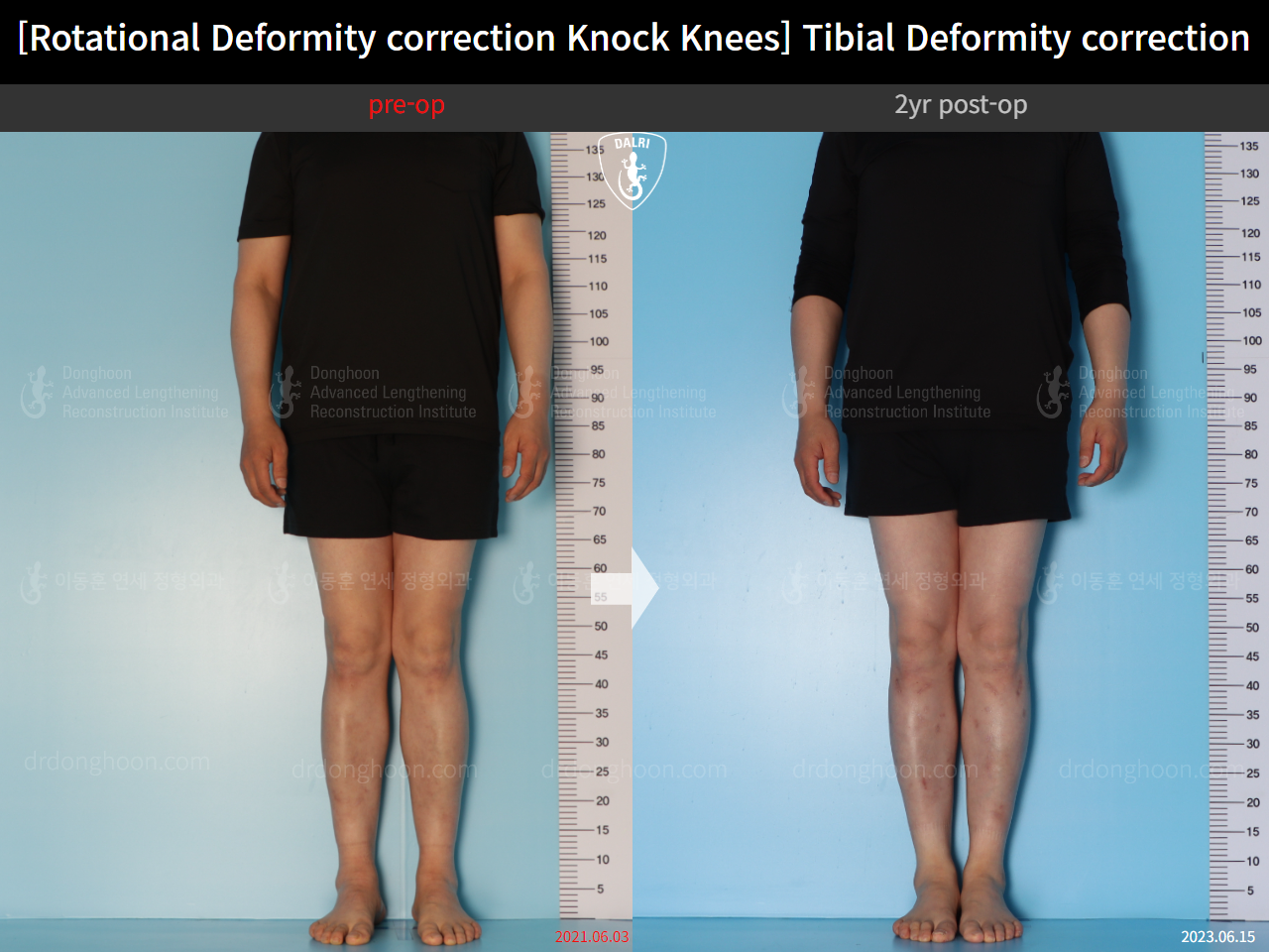 Before and after adult knock knees, case 15524370, image 1, Dr. Donghoon institute (DALRI)