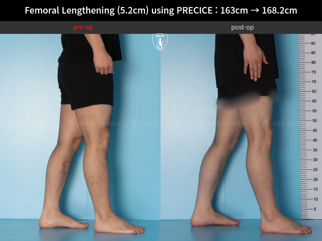 Before and after cll precice, case 55585697, image 10, Dr. Donghoon institute (DALRI)