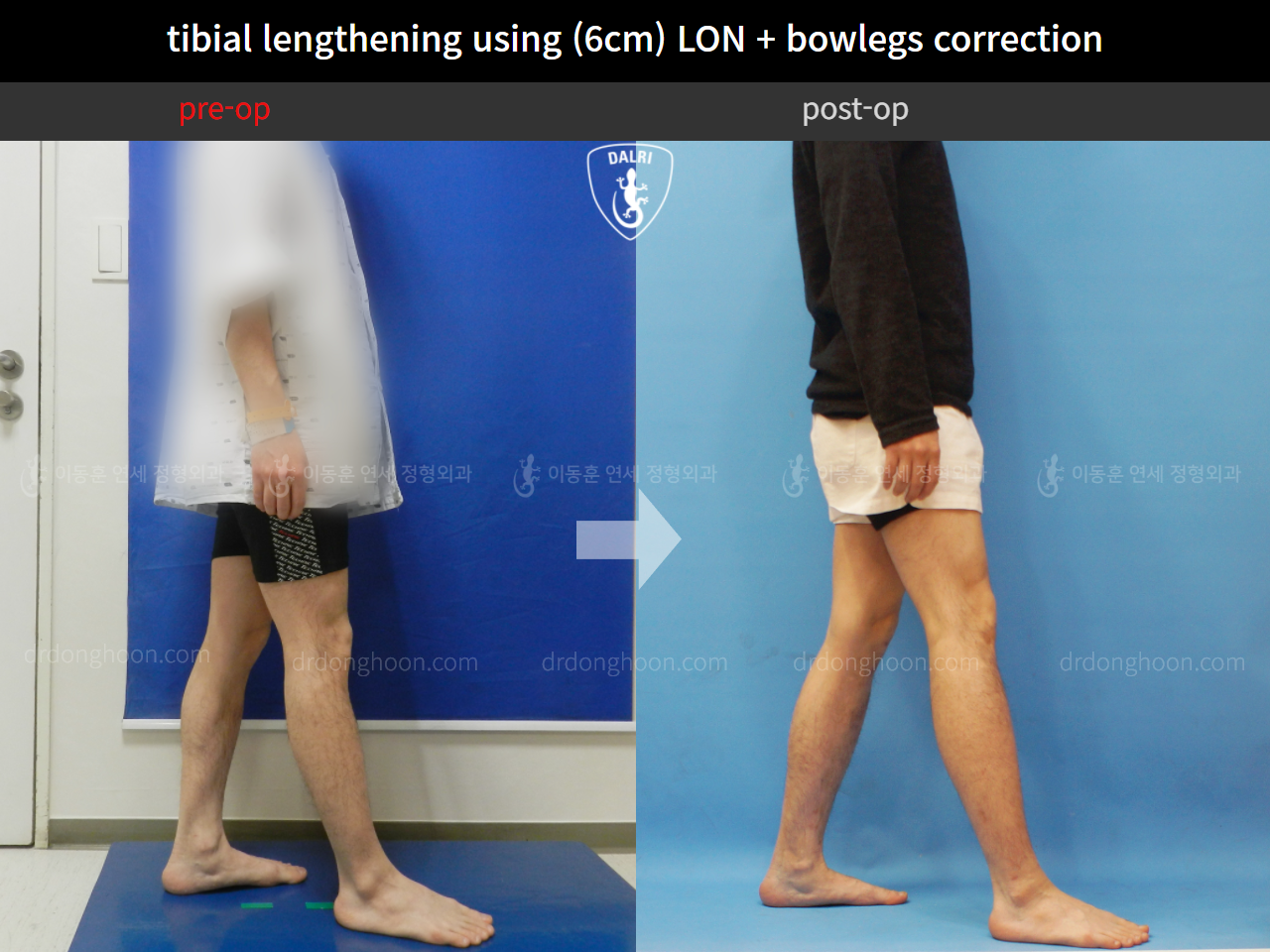 ภาพก่อน-หลัง ยืดขาพร้อมแก้ขาผิดรูป เคสที่ 11102001 ภาพที่ 3 จากโรงพยาบาลศัลยกรรมกระดูกลีดงฮุน (DALRI)